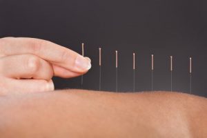 acupuncture pour maigrir remboursé